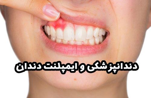 دندانپزشکی و ایمپلنت دندان