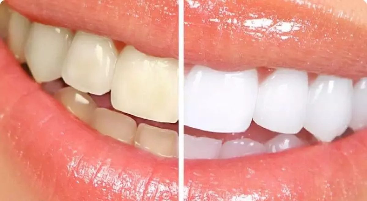 سفید کردن دندان در خانه